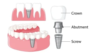 all-on-6-dis-implan-tedavisi-istanbul