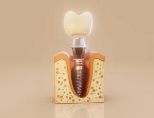 mini-ince-implant-tedavisi-istanbul