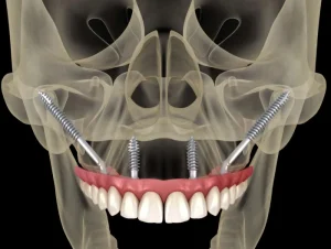 zigomatik-dis-implant-tedavisi-istanbul